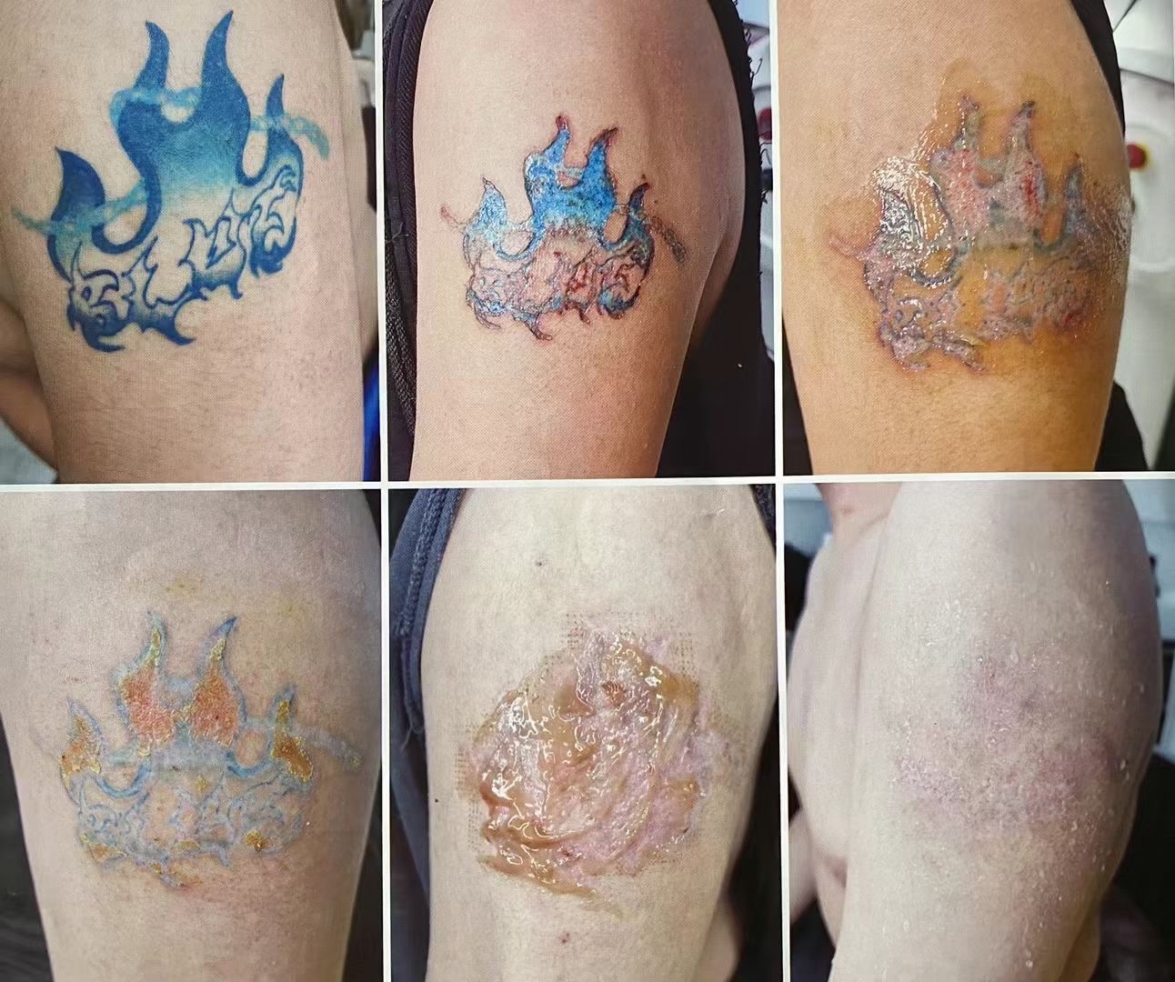 洗纹身前后效果案例03