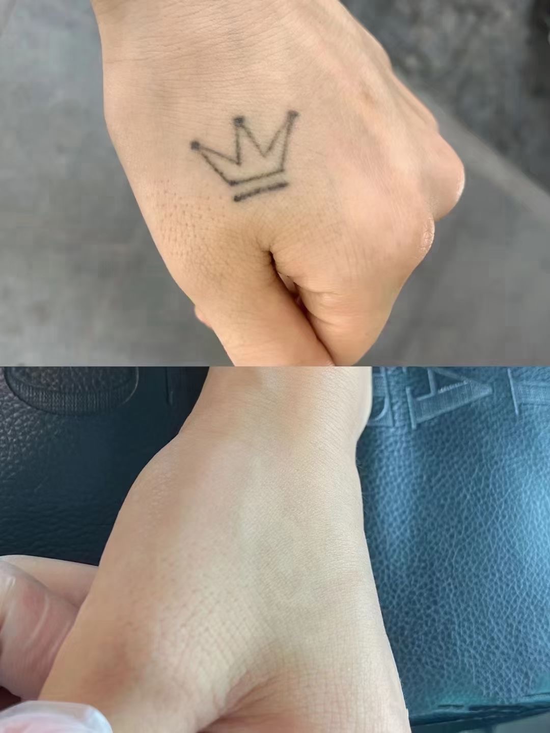 洗纹身前后效果案例05